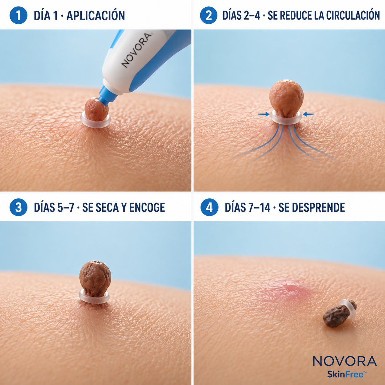 SkinFree | Kit Removedor de Verrugas Colgantes
